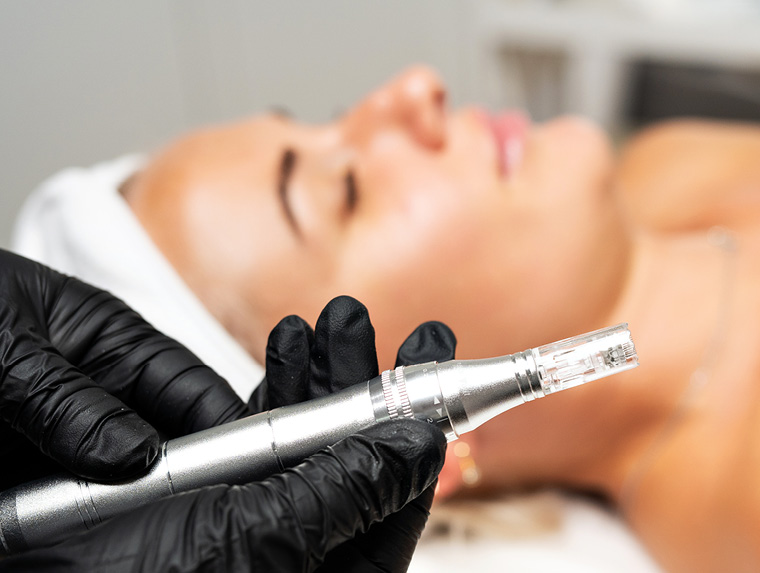 Microneedling 5er Karte -je 60 min